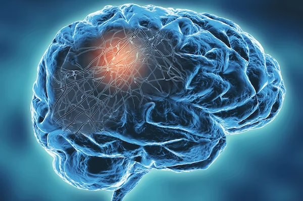 What the first signs of Parkinson's