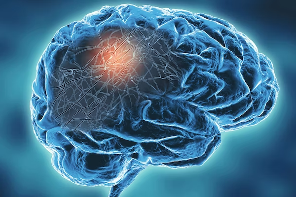 What the first signs of Parkinson's