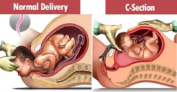 Natural Birth vs C-Section