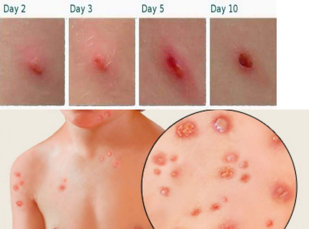 The classic symptom of chickenpox is a red, itchy rash that usually starts on the face, chest, and back and then spreads to other parts of the body ..