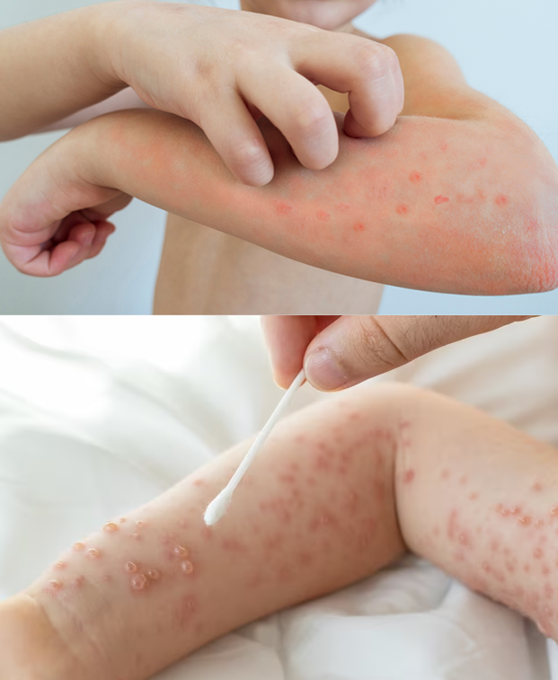 Scratch the blisters, as this can lead to infection and scarring.