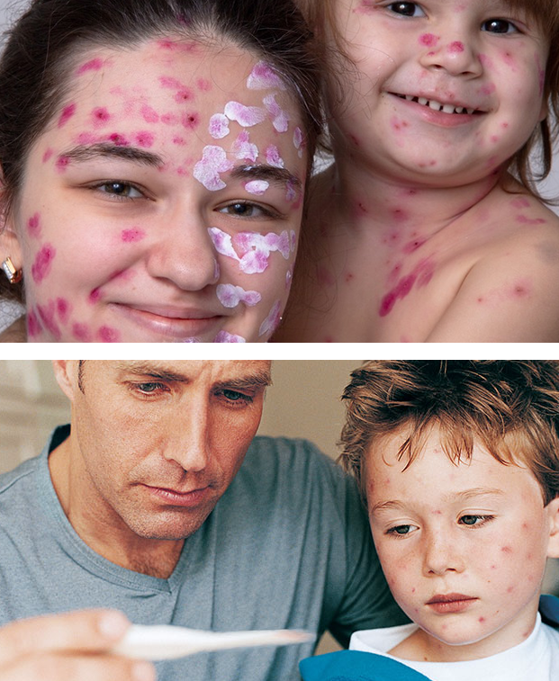 it is recommended that a child with chickenpox be isolated to prevent the spread of the virus to others