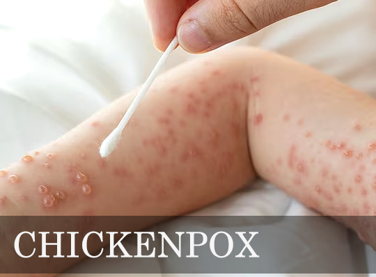 What are the 6 symptoms of chickenpox
