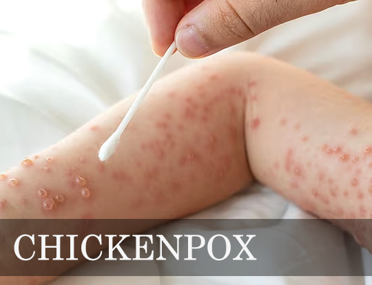 What are the 6 symptoms of chickenpox
