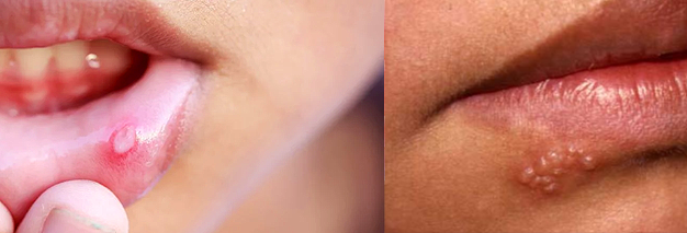 Oral and genital ulcers: These are the most common and characteristic symptoms of Behcet's