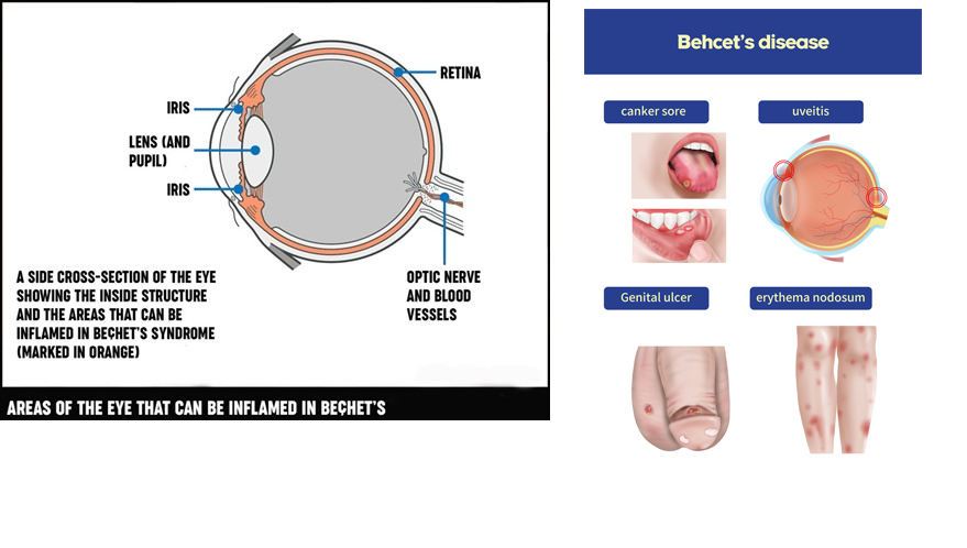 Behcet's disease can increase the risk of blood clots, which can be life-threatening if they occur in the lungs, brain, or other vital organs.