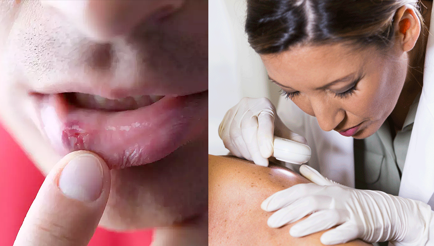 If you are experiencing symptoms that could be related to Behcet's disease, it's important to see a doctor for a proper evaluation and diagnosis