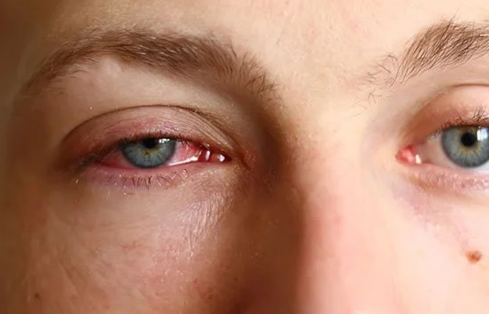 Behçets Disease: Symptoms, Treatments, Risk of Blindness, Can it be cured ?