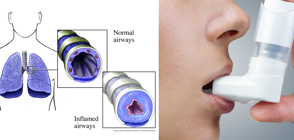 How does corticosteroids work in asthma?