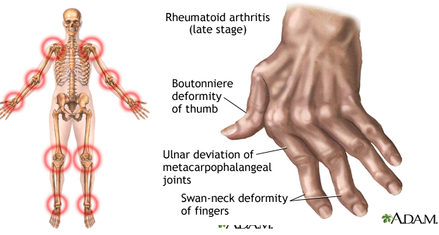 symptoms of rheumatism