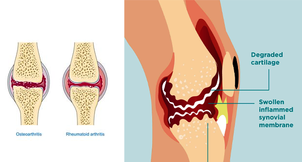 Some studies have found that people with a history of chlamydia infection may be at an increased risk of developing rheumatoid arthriti