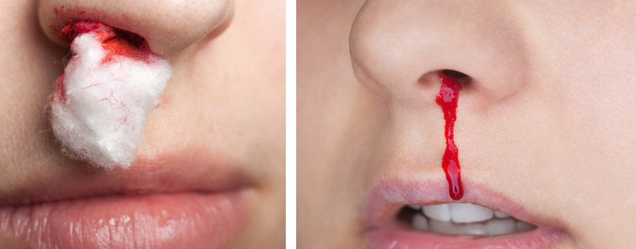 Sit upright and lean slightly forward, to prevent blood from flowing down the throat and to reduce blood pressure in the veins of the nose