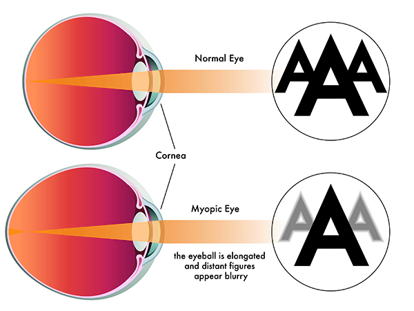 Astigmatism vs. Myopia