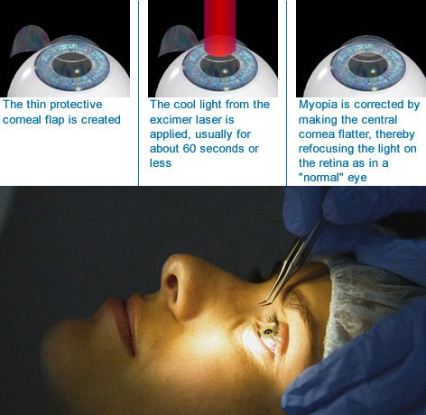 laser treatment for myopia