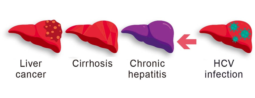 Without treatment, hepatitis C can cause liver damage and lead to serious liver conditions