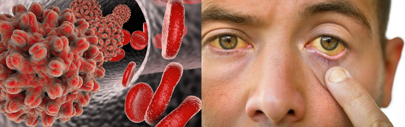 hepatitis's B symptoms