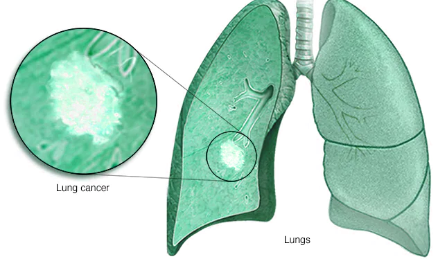 common causes of cancer