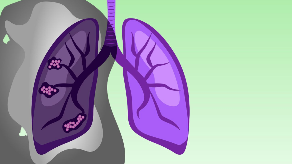The survival rate for lung cancer varies widely depending on several factors,
