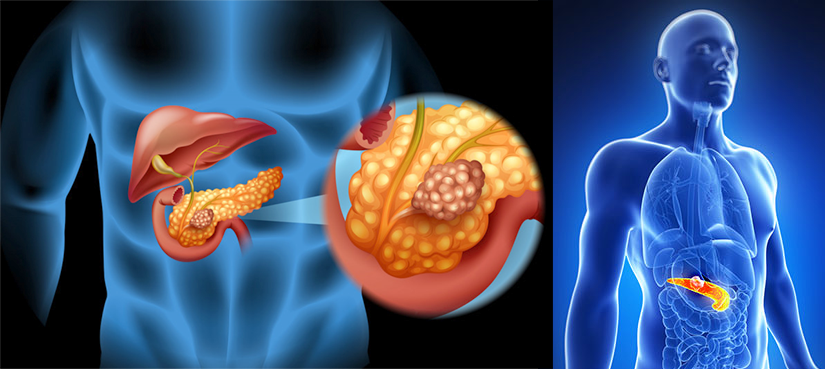 warning signs of pancreatic cancer
