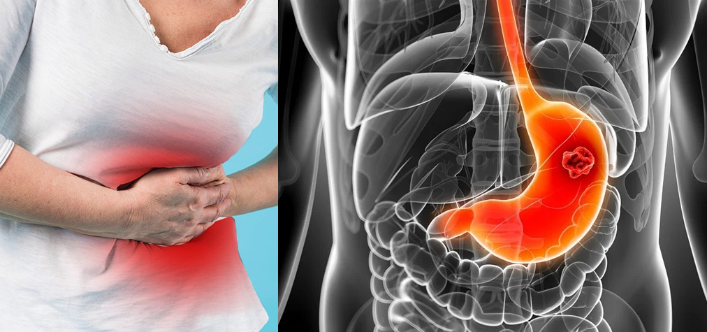Treatment for stomach (Gastric ) cancer