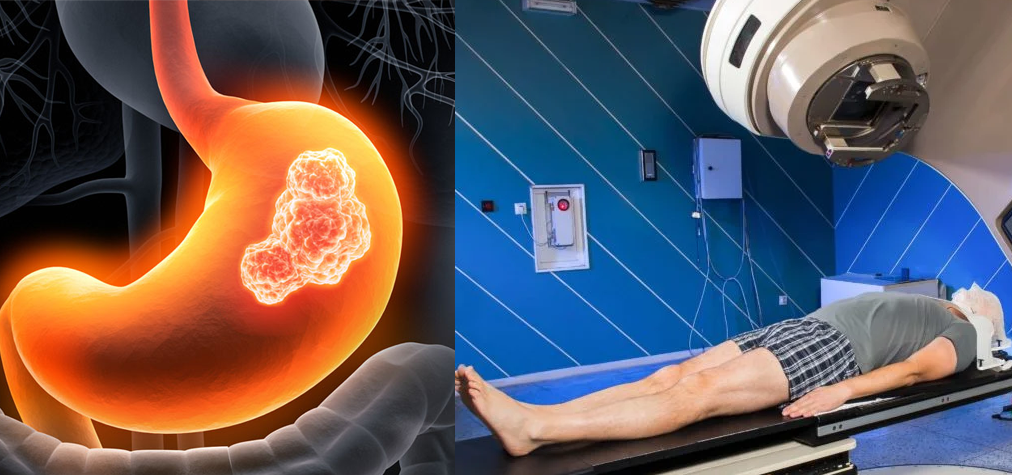 Treatment for stomach cancer