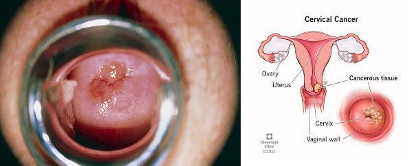 In general, cervical cancer is more common than uterine cancer.