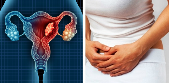 The main cause of uterine cancer is an abnormal growth of cells in the lining of the uterus
