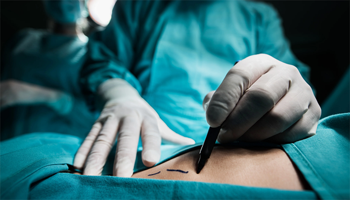 Surgery is often the first-line treatment for liver cancer. The surgeon may remove the tumor along with a portion of healthy liver tissue (partial hepatectomy)