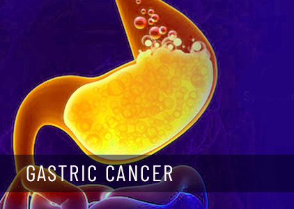 Stomach (Gastric ) cancer: Symptoms, cause & treatment
