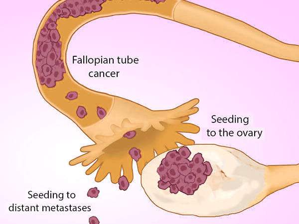 Women with a personal or family history of these cancers may be at increased risk for developing fallopian tube cancer.