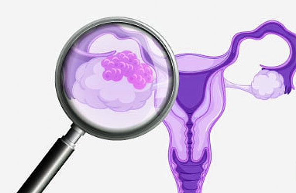 fallopian tube cancer is often diagnosed at an advanced stag