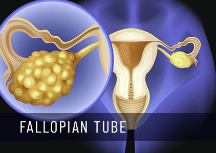 Fallopian Tube Cancer: Causes, Symptoms & Treatment