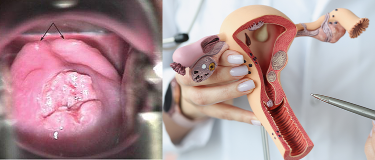  Regular gynecological exams and Pap tests can help detect vaginal cancer early, when it's most treatable