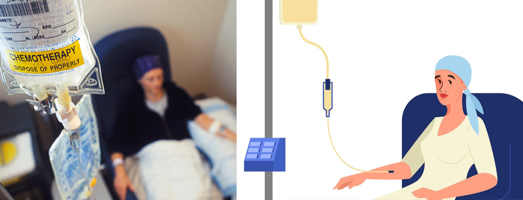 Chemotherapy may be used before or after surgery to shrink the tumor (ovarian cancer)