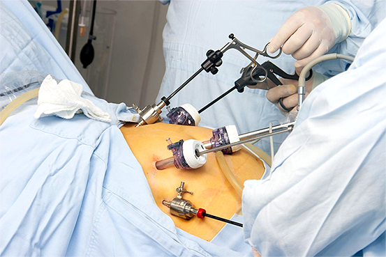 Gastric sleeve surgery: In this procedure, a large portion of the stomach is removed, leaving a small sleeve-shaped stomach