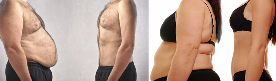 negative effects of bariatric surgery