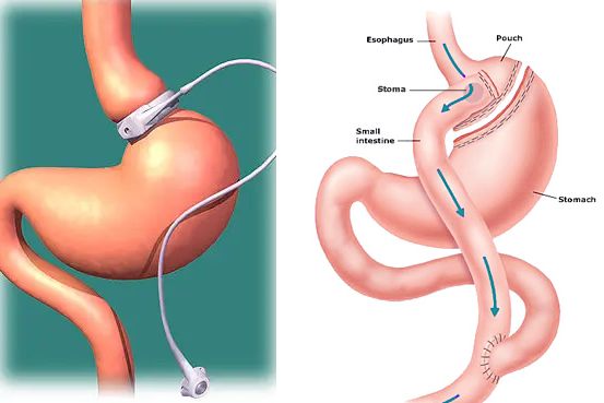 Most patients will continue to lose weight steadily for the first 6-12 months after Bariatric surgery