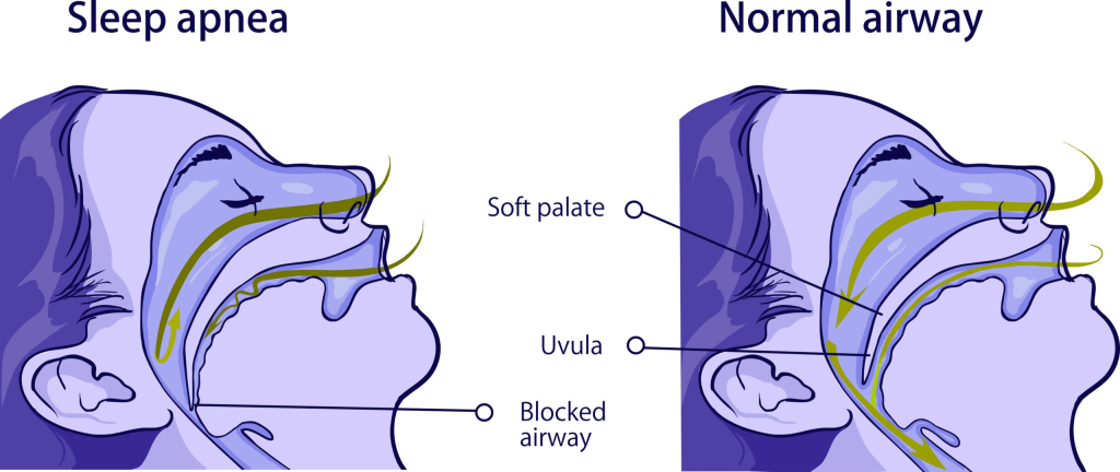Sleep apnea is caused by the partial or complete obstruction of the airway during sleep