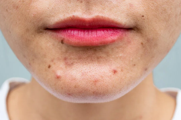 causes of acne? Which foods cause it ?