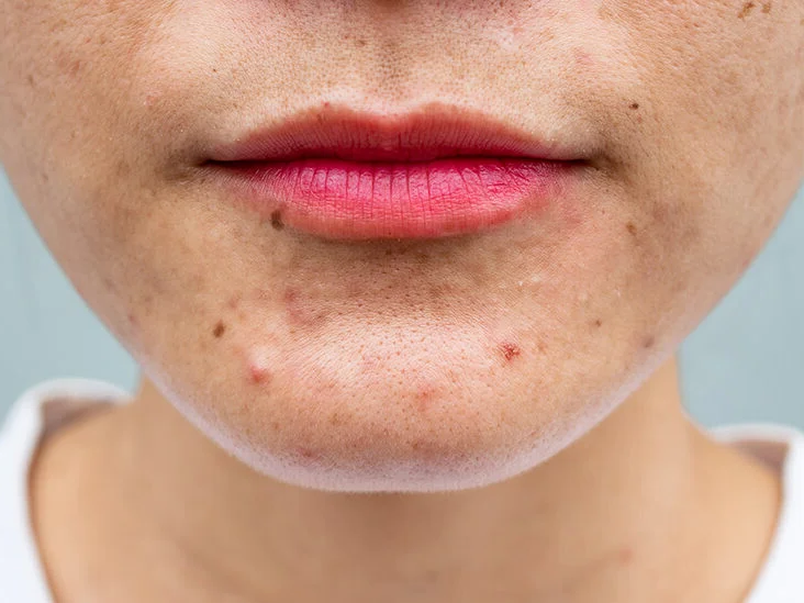 causes of acne? Which foods cause it ?