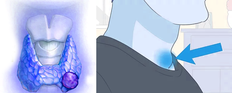 Family history of thyroid cancer or other related conditions such as goiter or thyroid nodules can increase the risk of developing the disease.