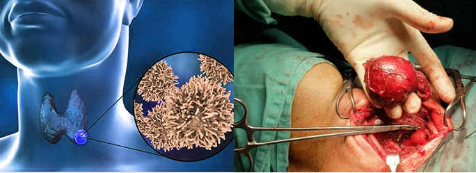 The main treatment for thyroid cancer is surgery to remove the thyroid gland (thyroidectomy)