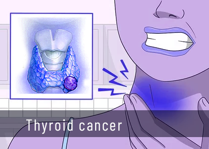 Thyroid cancer - Symptoms and causes