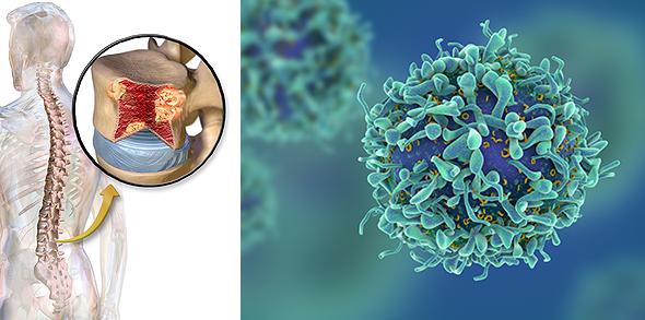 6 main cause of Myeloma cancer