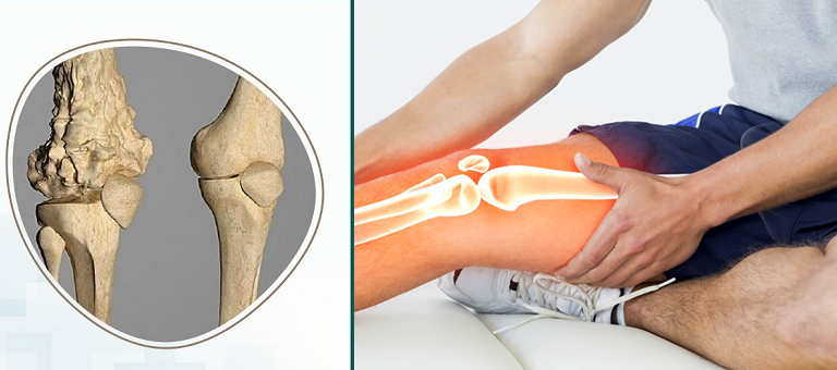 Difference Between Bone Cancer & Multiple Myeloma