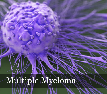 Multiple Myeloma - Blood Cancer Symptoms and Signs