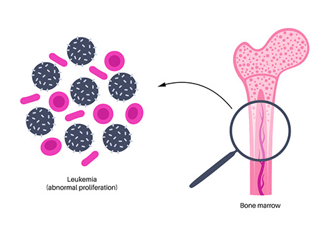 Chemotherapy: This involves the use of powerful drugs to kill Leukemia cancer cells