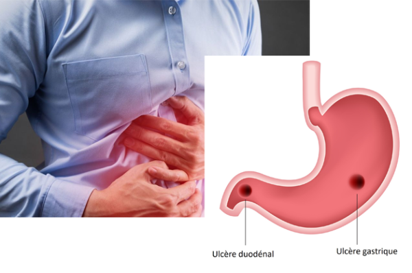 What are main causes of ulcers?