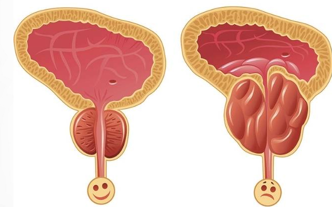 What are the types of prostate cancer
