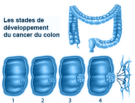 What are causes of colon cancer?
